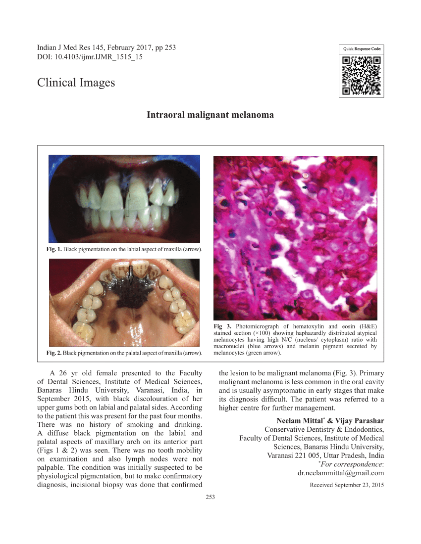 Pdf Intraoral Malignant Melanoma 