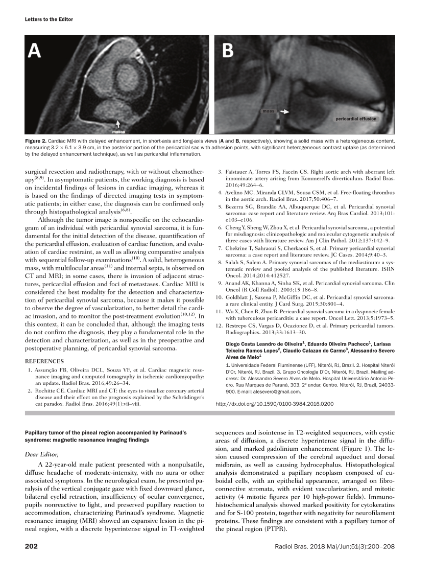 PDF Papillary tumor of the pineal region accompanied by  