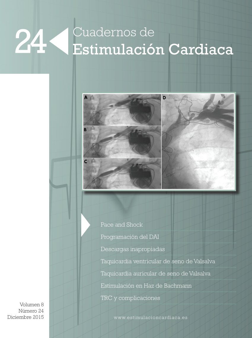 Pdf Estimulacion Auricular En El Haz De Bachmann