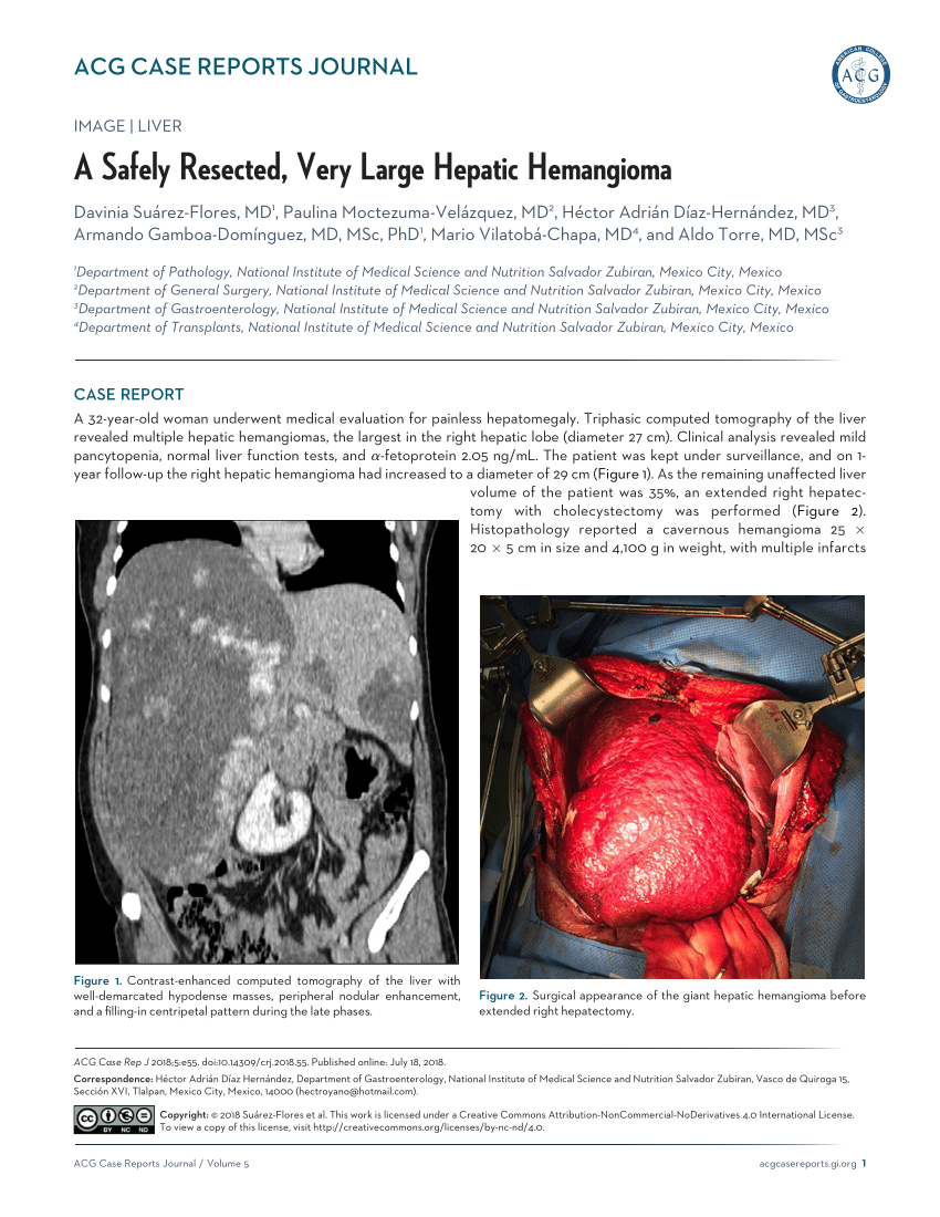 Pdf A Safely Resected Very Large Hepatic Hemangioma