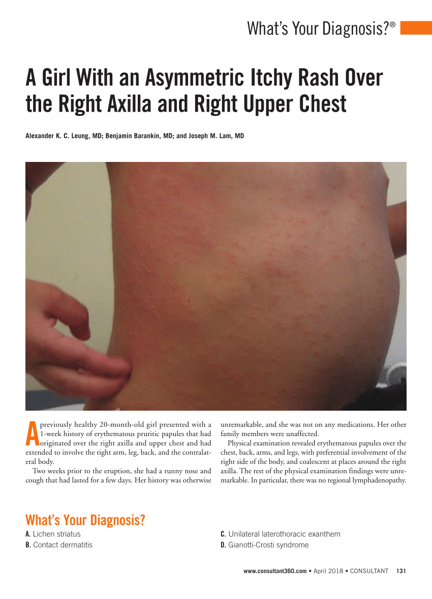 PDF) A girl with an asymmetric itchy rash over the right axilla and right  upper chest