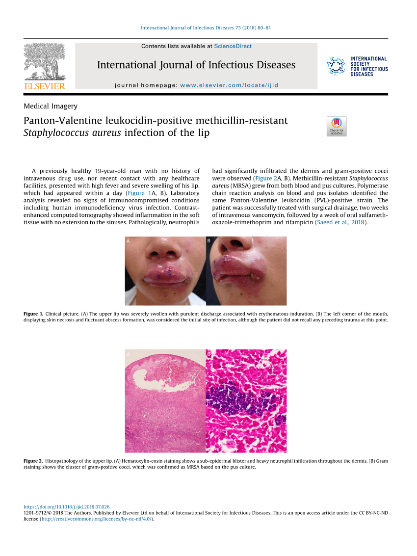 icd 10 code soft tissue swelling of lip