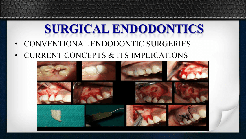 Pdf Surgical Endodontics Guest Lecture 