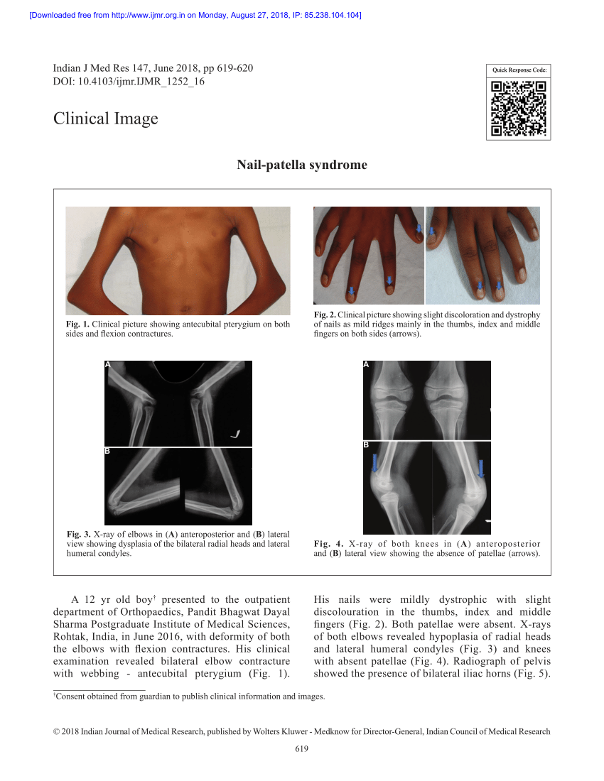 PDF) Do you know this syndrome? Nail patela syndrome: A pathognomonic  dermatologic finding