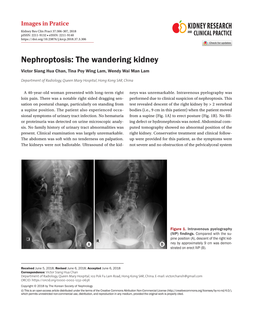 what is meant by wandering kidney