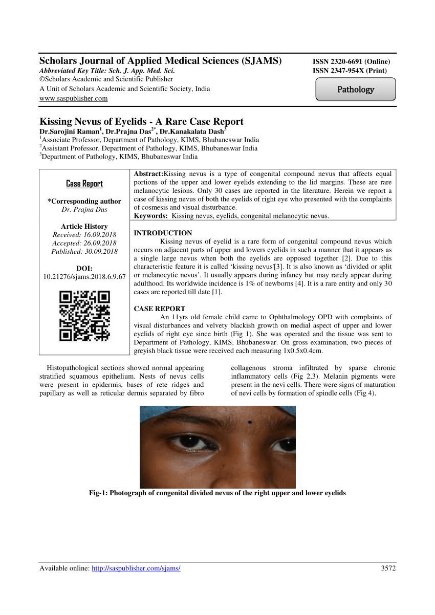 (PDF) Kissing Nevus of Eyelids - A Rare Case Report