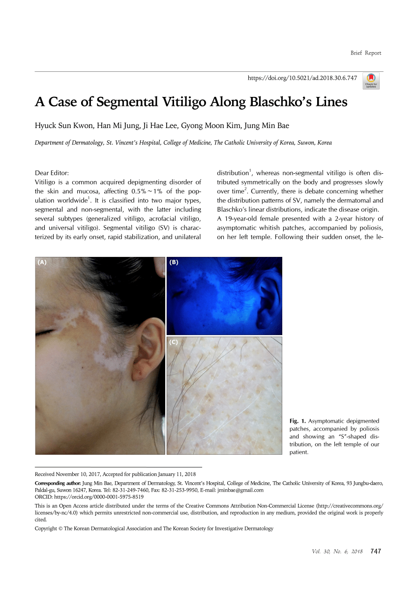 case study on vitiligo