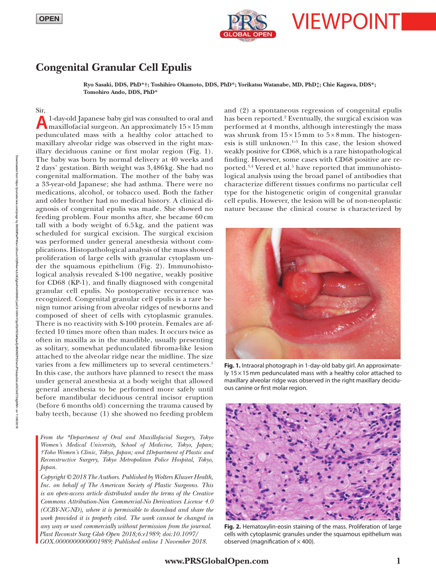 [PDF] Congenital Granular Cell Epulis