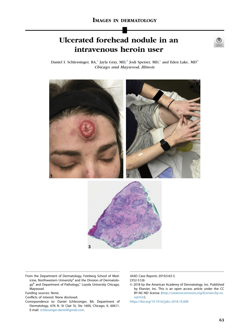 Pdf Ulcerated Forehead Nodule In An Intravenous Heroin User