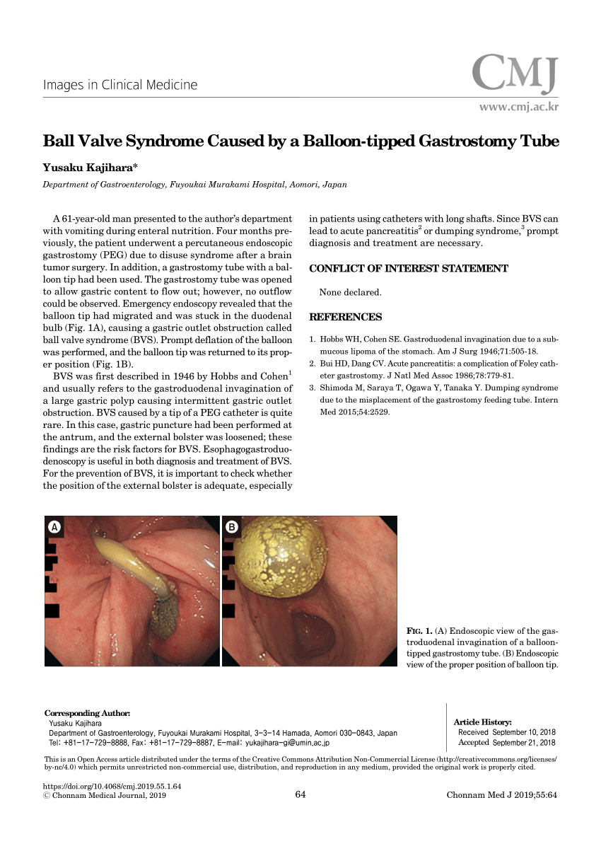 pdf-ball-valve-syndrome-caused-by-a-balloon-tipped-gastrostomy-tube