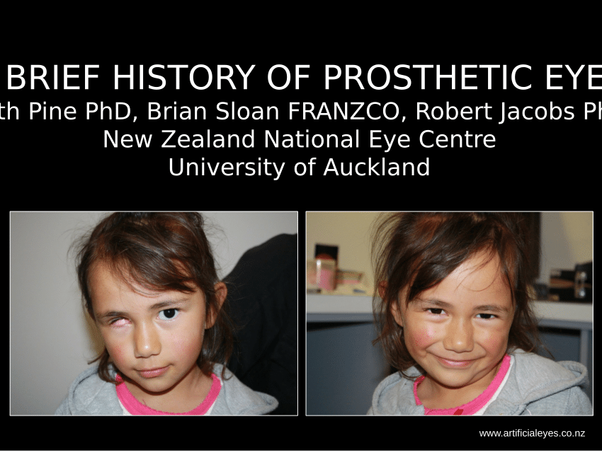 The History and Evolution of Prosthetic Eyes, Blog