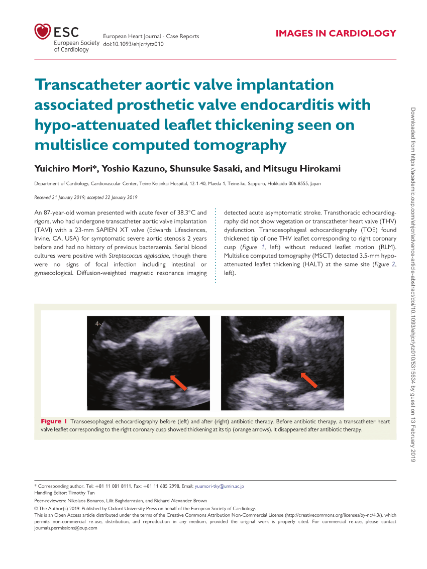 Pdf Transcatheter Aortic Valve Implantation Associated Prosthetic