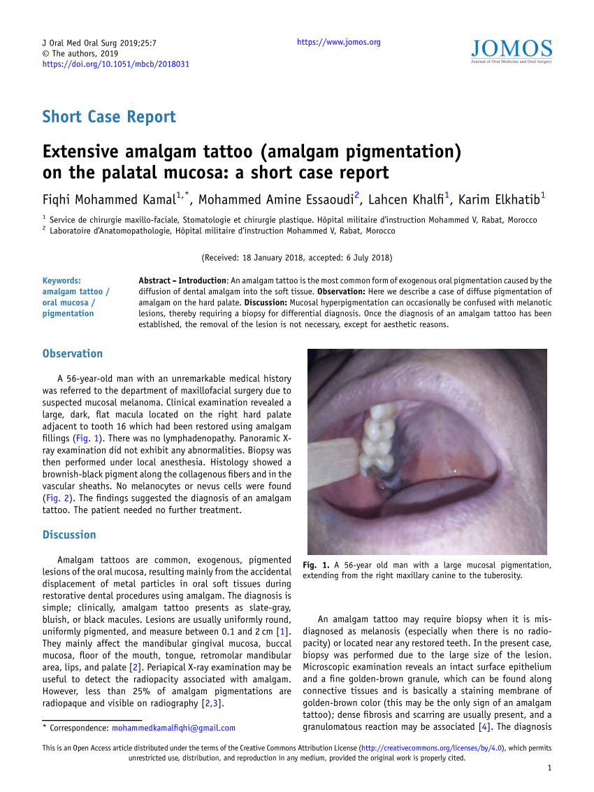 PDF) Extensive amalgam tattoo (amalgam pigmentation) on the palatal mucosa:  a short case report