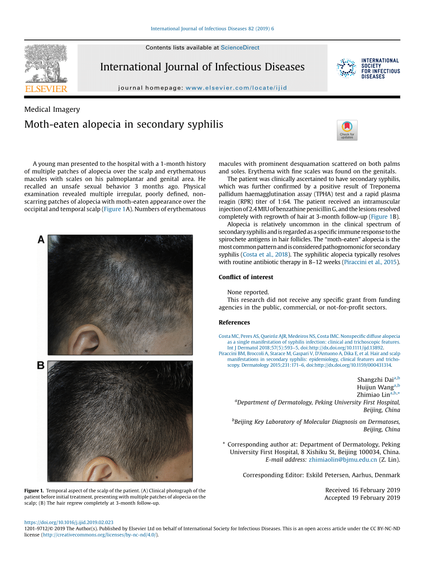 pdf-moth-eaten-alopecia-in-secondary-syphilis