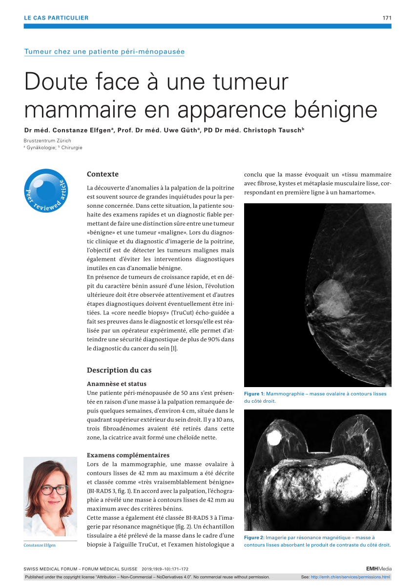 PDF) Doute face à une tumeur mammaire en apparence bénigne