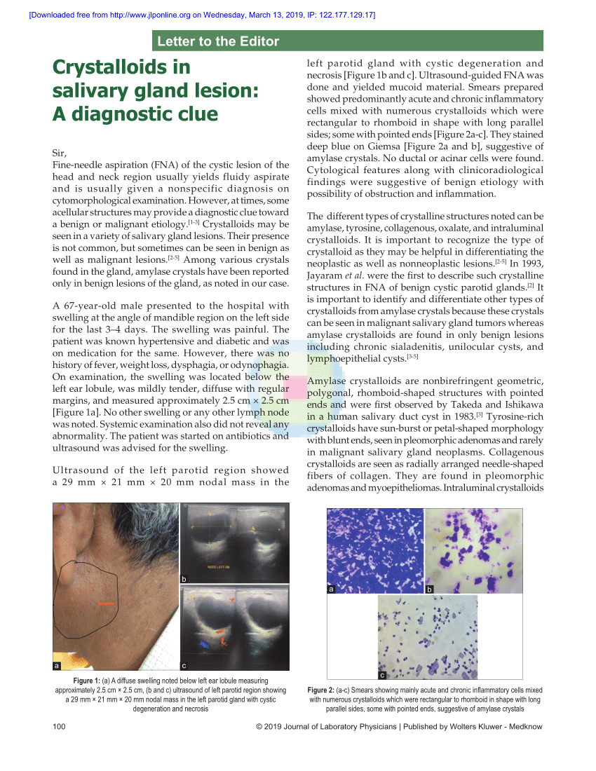 (PDF) Crystalloids in salivary gland lesion: A diagnostic clue