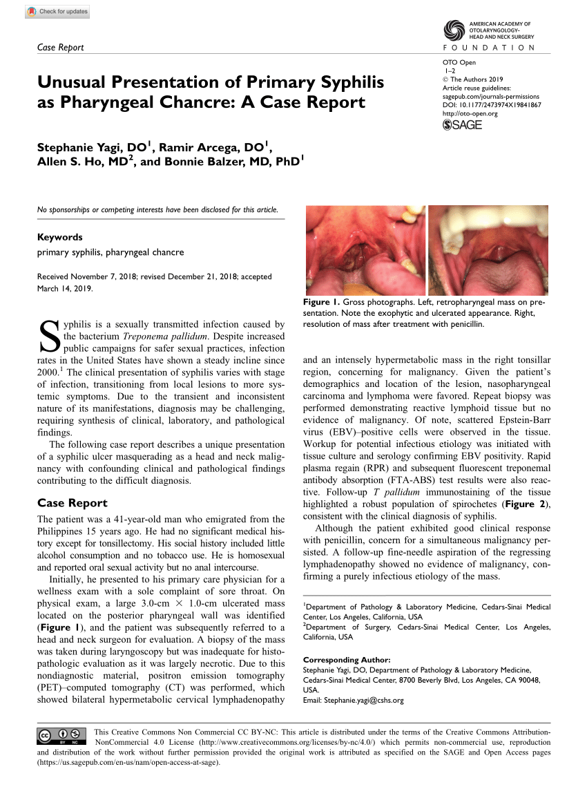 Pdf Unusual Presentation Of Primary Syphilis As Pharyngeal Chancre A