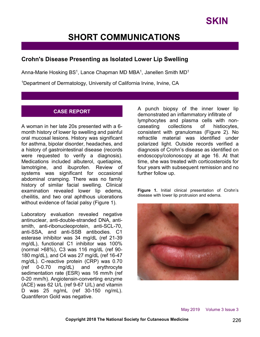 (PDF) Crohn's Disease Presenting as Isolated Lower Lip Swelling