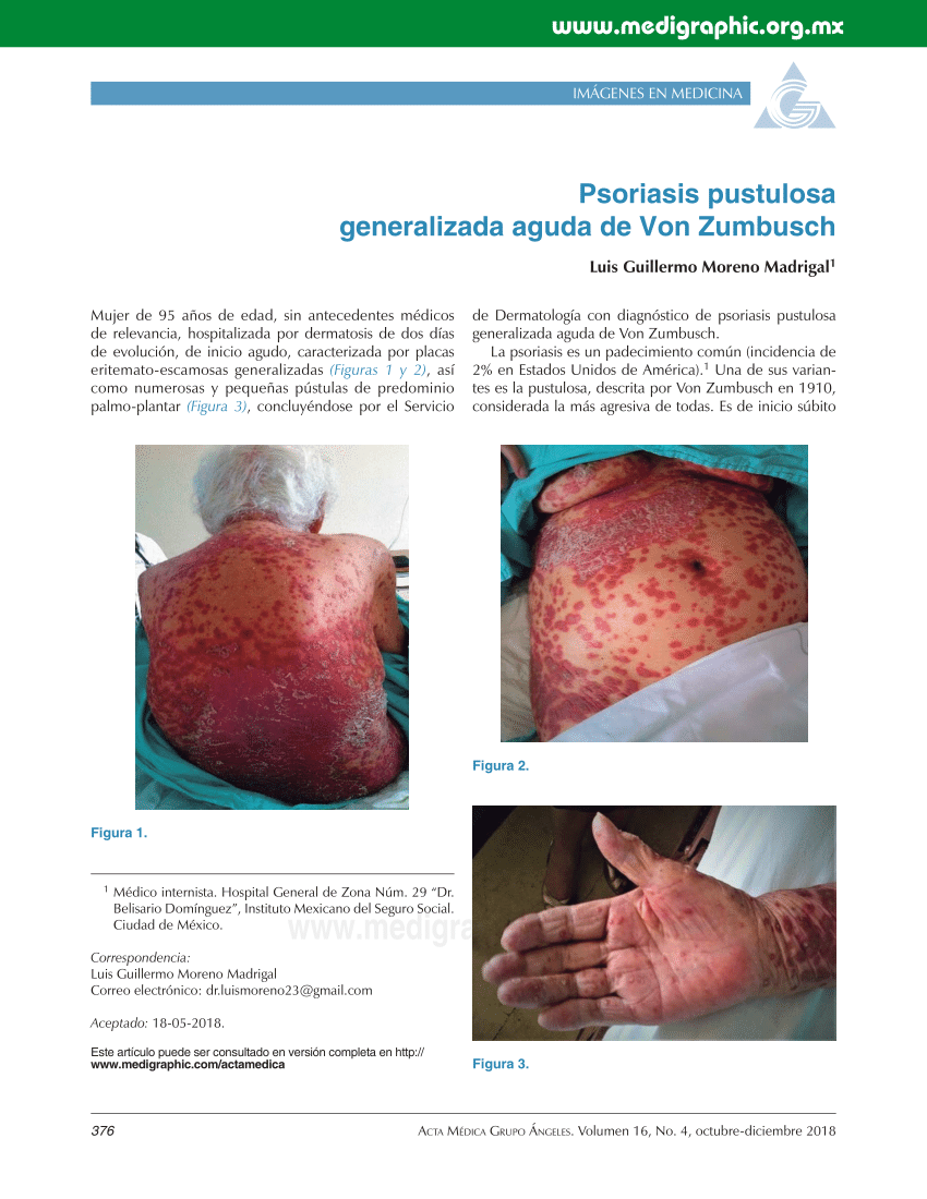 Pdf Acute Generalized Pustular Psoriasis Of Von Zumbusch