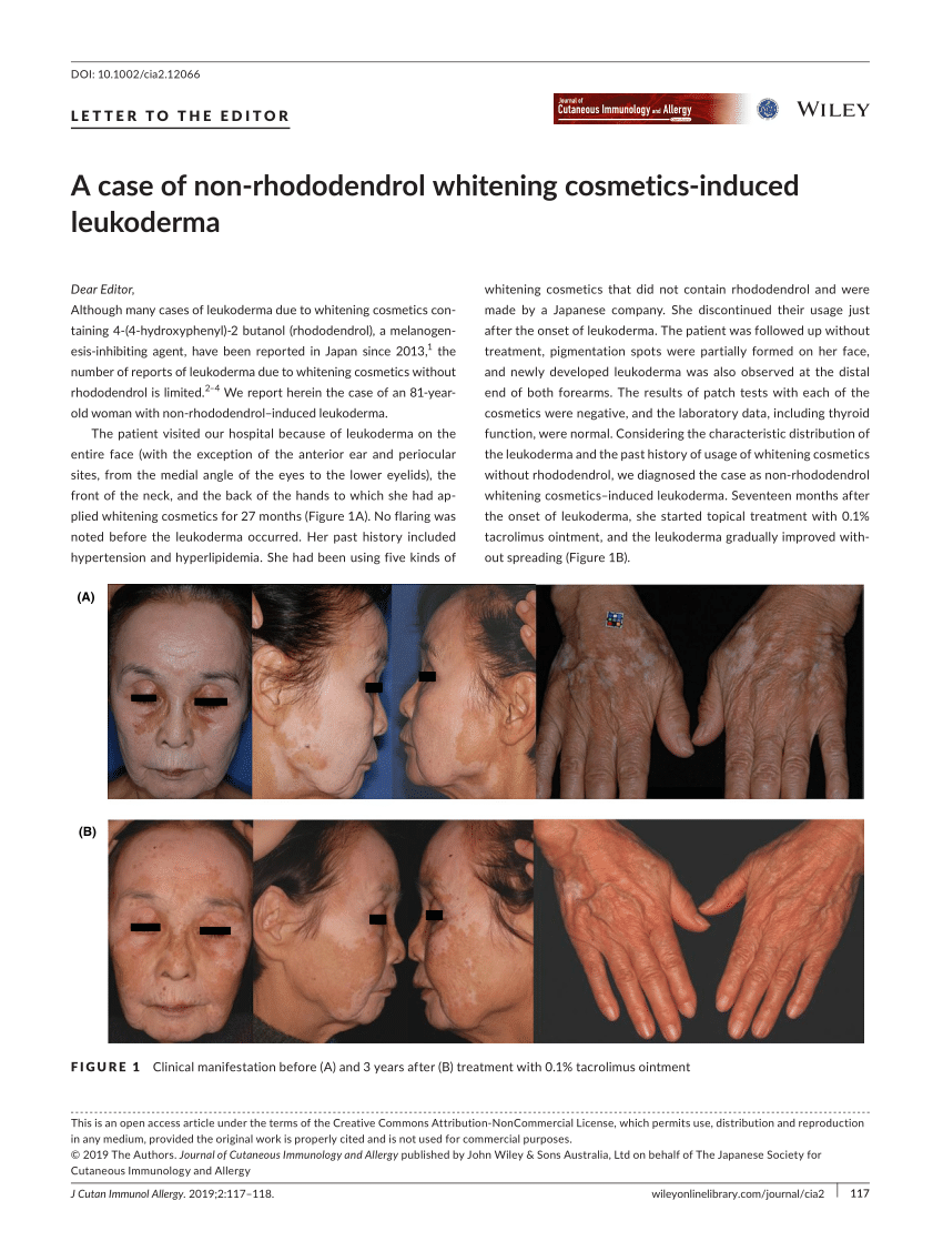 (PDF) A case of non‐rhododendrol whitening cosmetics‐induced