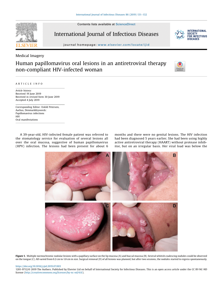 Human papilloma lesions
