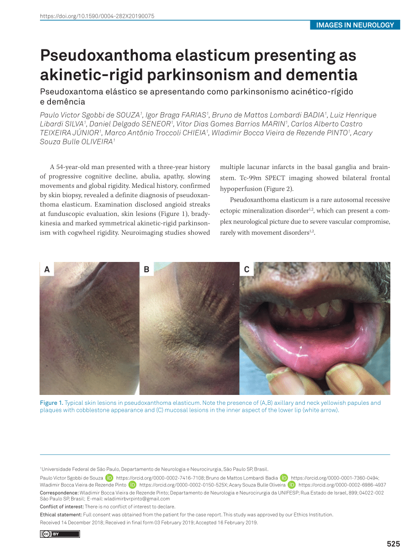 Pdf Pseudoxanthoma Elasticum Presenting As Akinetic Rigid Parkinsonism And Dementia 4341