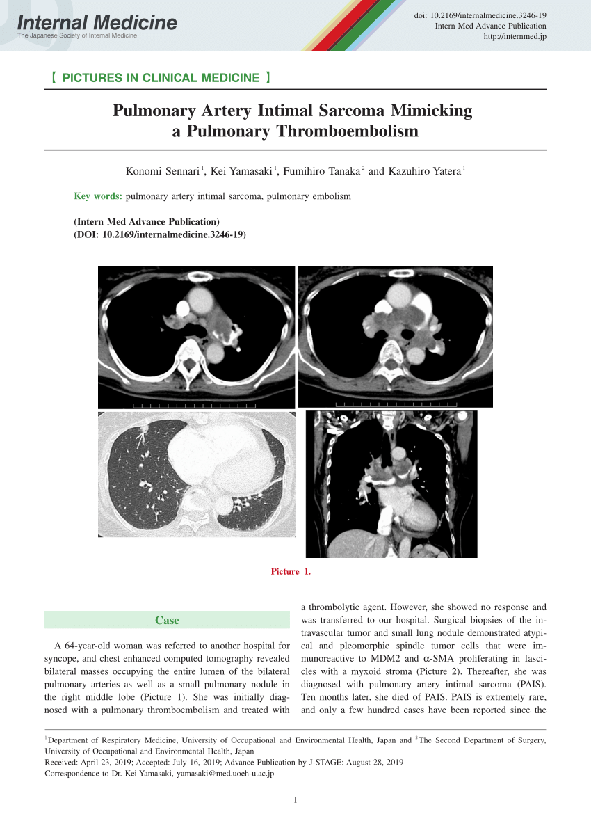 An intimal sarcoma of pulmonary artery mimicking pulmonary