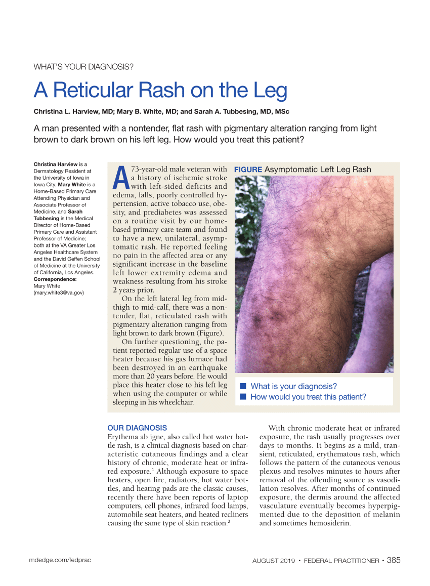 A reticular eruption on the thighs  Cleveland Clinic Journal of Medicine