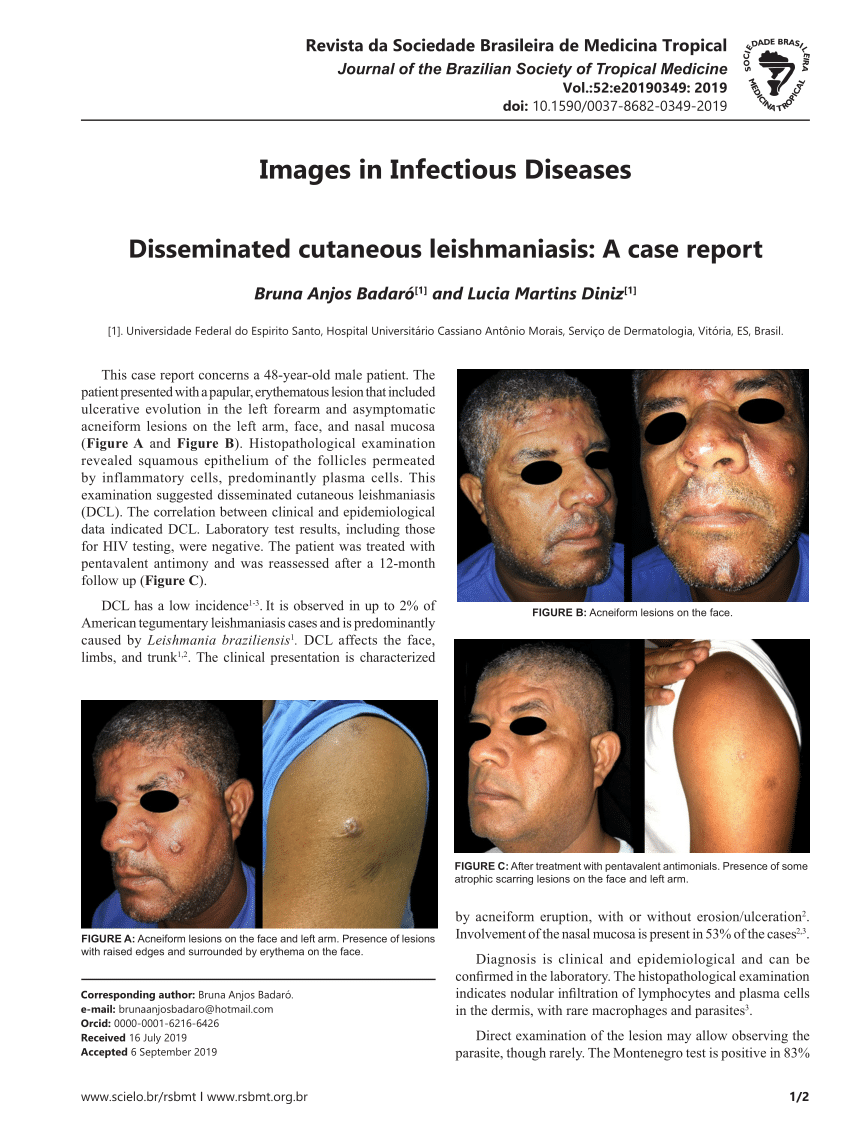 Pdf Disseminated Cutaneous Leishmaniasis A Case Report