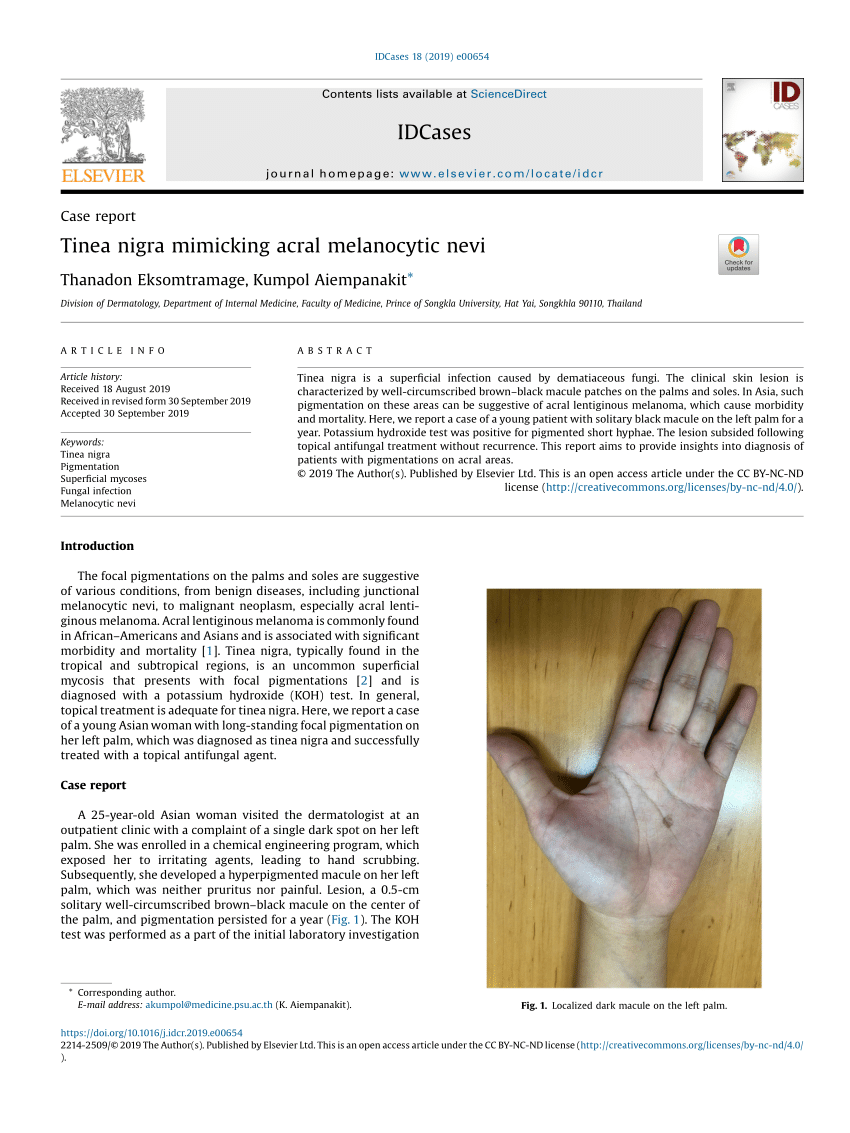 Figure 1 from Tinea nigra: Report of three pediatrics cases.
