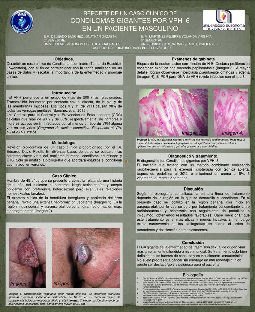 Diagnosticul masculin condilom. Genital Warts (Condylomata Acuminata) papillomaviridae vaccine