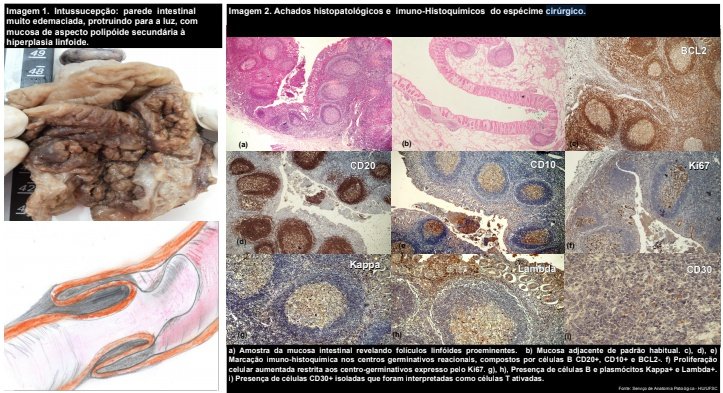 PDF) Hiperplasia Folicular Linfoide em Intussuscepção Recorrente da  infância - Relato de Caso