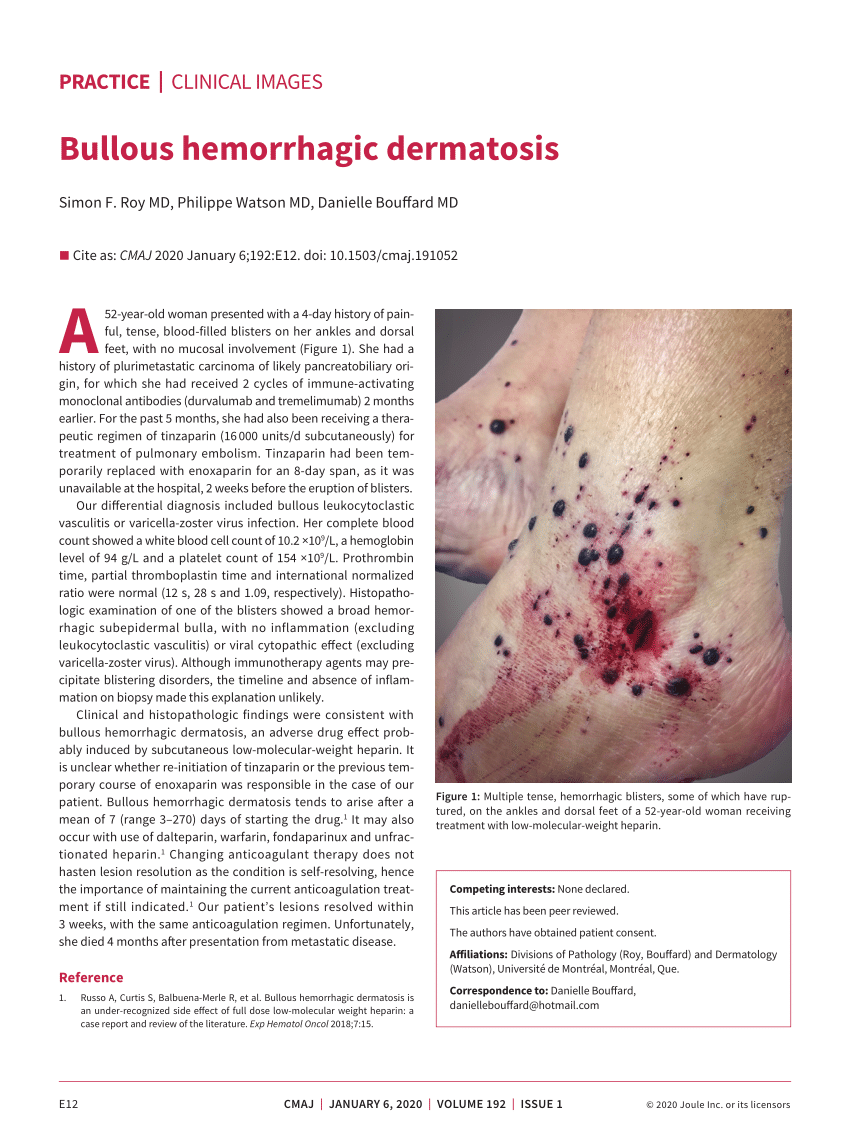 Pdf Bullous Hemorrhagic Dermatosis