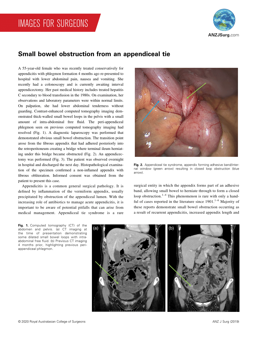 PDF Small bowel obstruction from an appendiceal tie