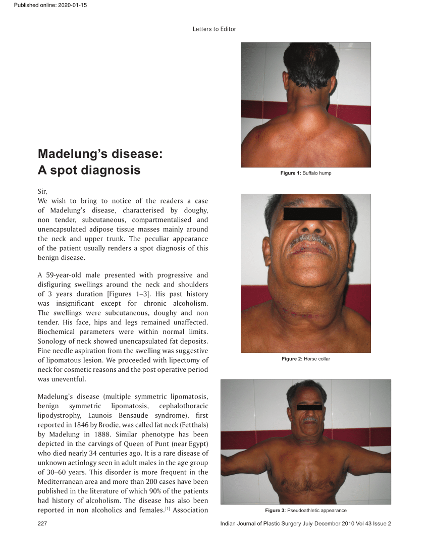 Pdf Madelungs Disease A Spot Diagnosis 