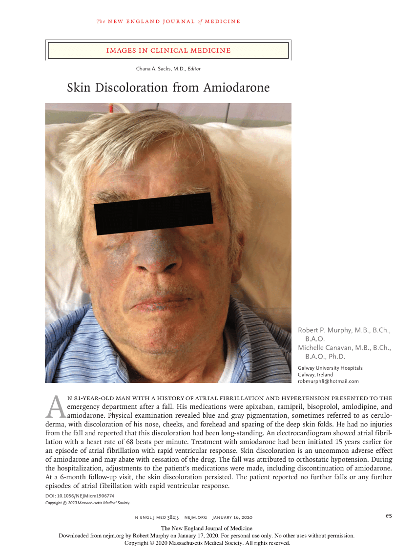 Skin Discoloration from Amiodarone