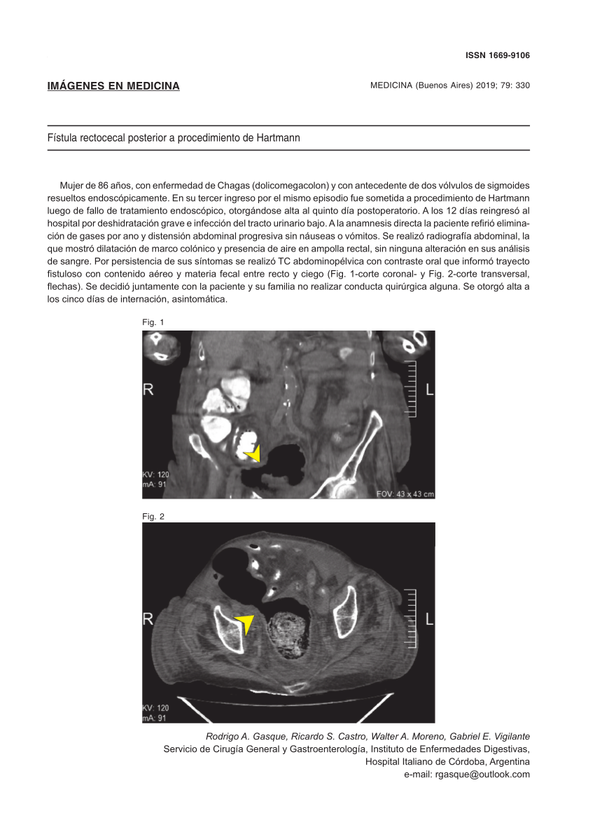 PDF Fístula rectocecal posterior a procedimiento de Hartmann