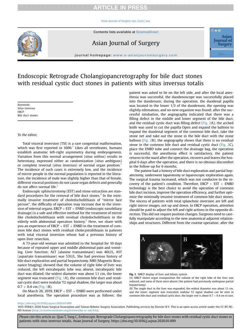 Pdf Endoscopic Retrograde Cholangiopancretography For Bile Duct Stones With Residual Cystic Duct Stones In Patients With Situs Inversus Totalis