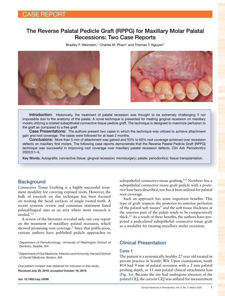 SciELO - Brasil - Effects of active and passive lacebacks on  antero-posterior position of maxillary first molars and central incisors  Effects of active and passive lacebacks on antero-posterior position of  maxillary first