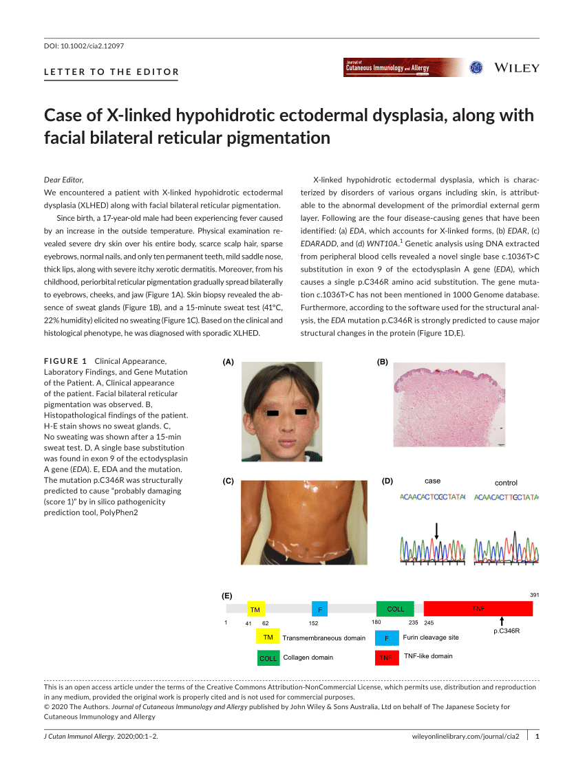 Pdf Case Of X‐linked Hypohidrotic Ectodermal Dysplasia Along With Facial Bilateral Reticular 4403