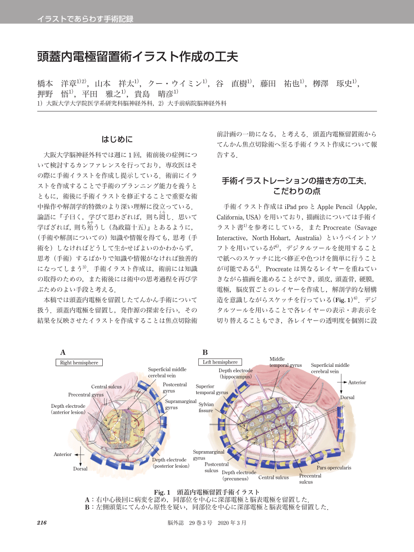 Pdf Neurosurgical Records By Represented Illustration 頭蓋内電極留置術イラスト作成の工夫