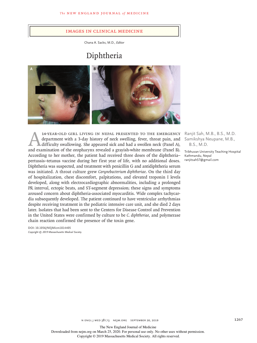 diphtheria case study pdf