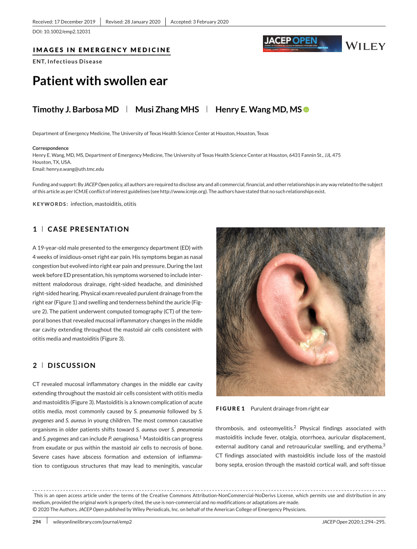 Pulsatile Tinnitus Causes & Treatments