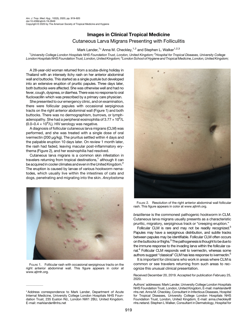 Pdf Cutaneous Larva Migrans Presenting With Folliculitis