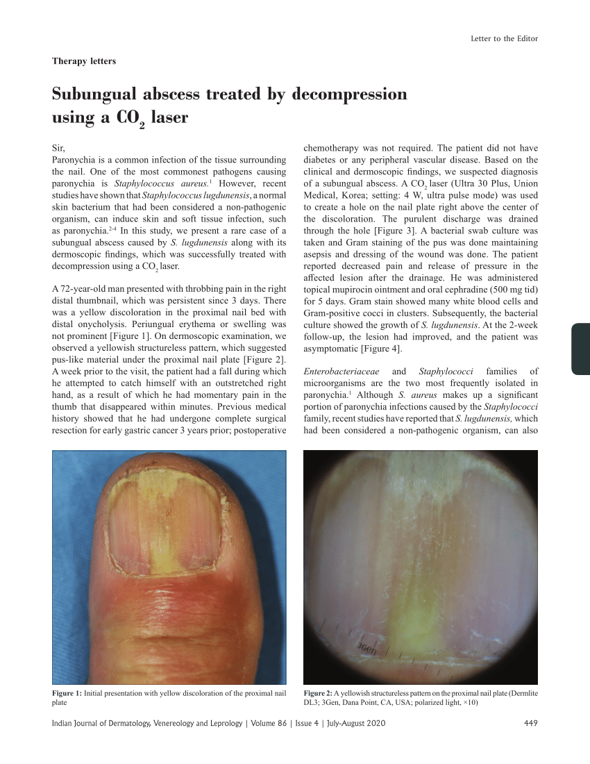 Bilateral Free 2nd Toe Pulp Flap for Reconstruction of Soft Tissue Defect  in Traumatic Finger Injuries