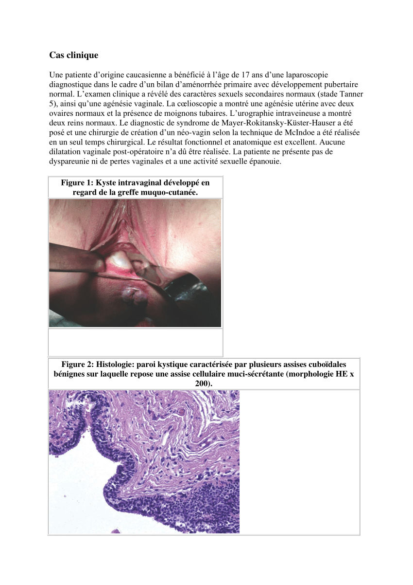 Pdf Syndrome De Rokitansky Kyste Vaginal Après Néo Vagin Selon La Technique Chirurgicale De 1115