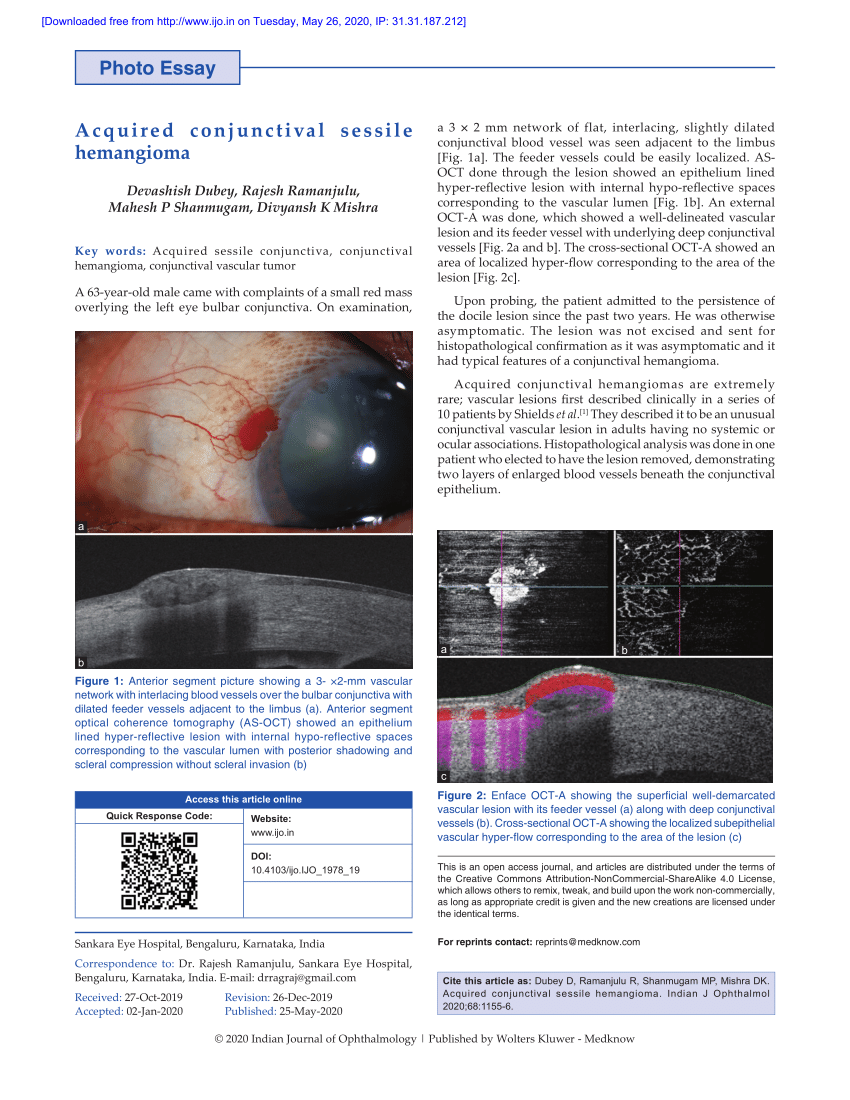 Pdf Acquired Conjunctival Sessile Hemangioma 