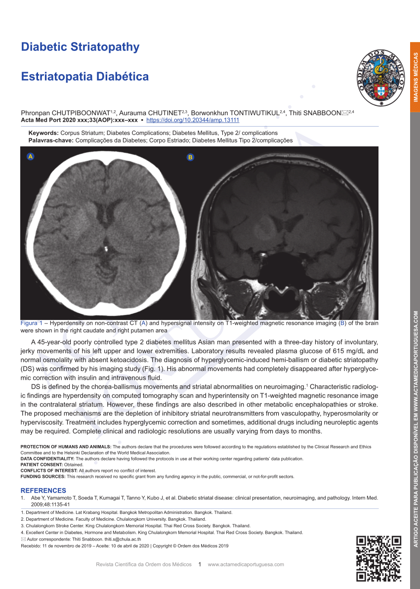 PDF Diabetic Striatopathy 