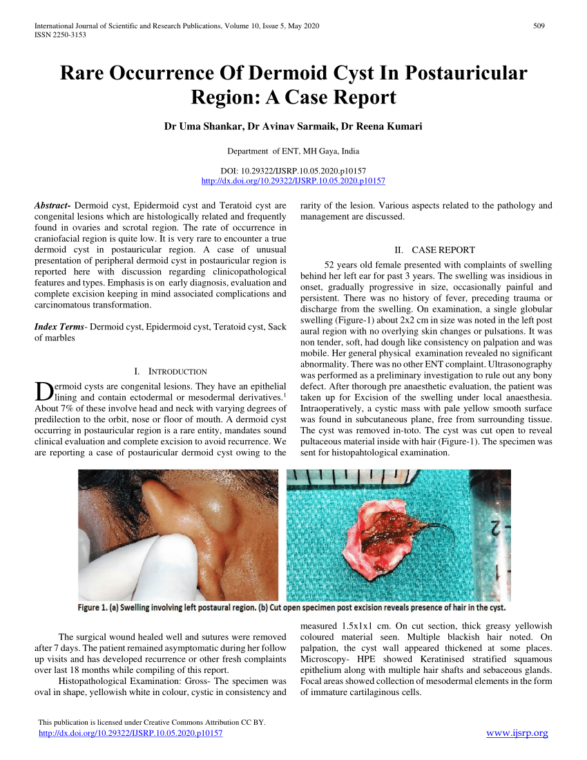 Pdf Rare Occurrence Of Dermoid Cyst In Postauricular Region A Case