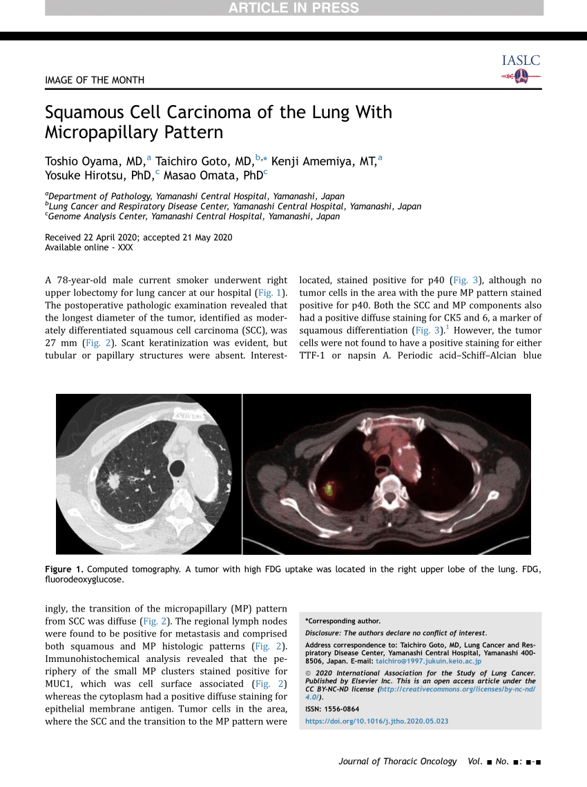 case study lung carcinoma